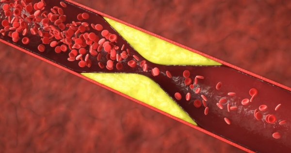 cholesterol